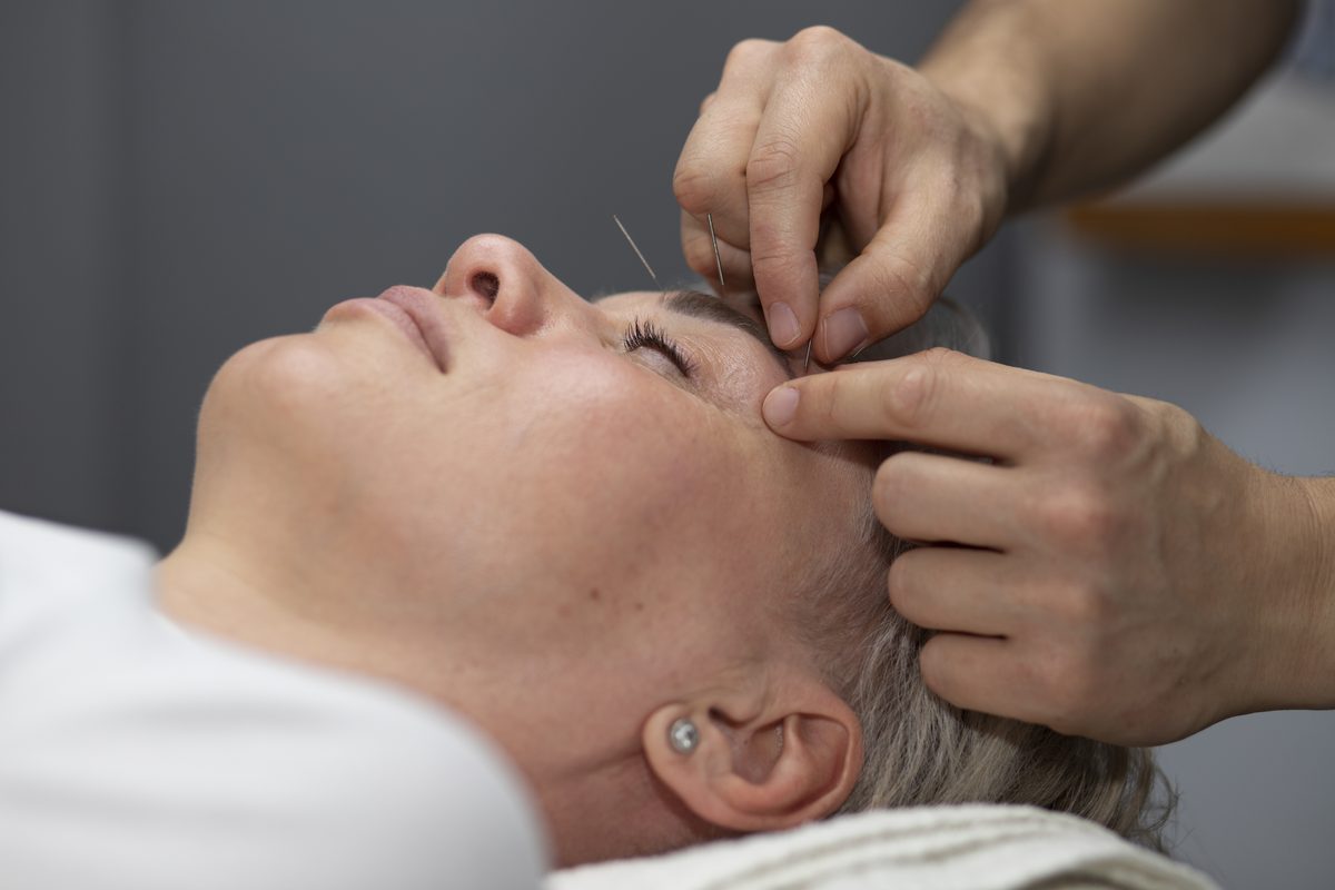 Cosmetic acupuncture facial treatment